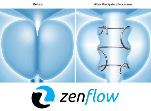 FDA Approves Zenflow Spring Implant and Delivery System for First-Line Interventional Therapy of Patients with Benign Prostatic Hyperplasia